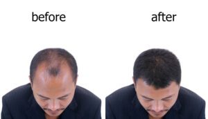 Before and After a hair transplant in Turkey