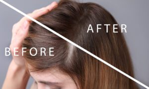 Hair Transplants for Women Results