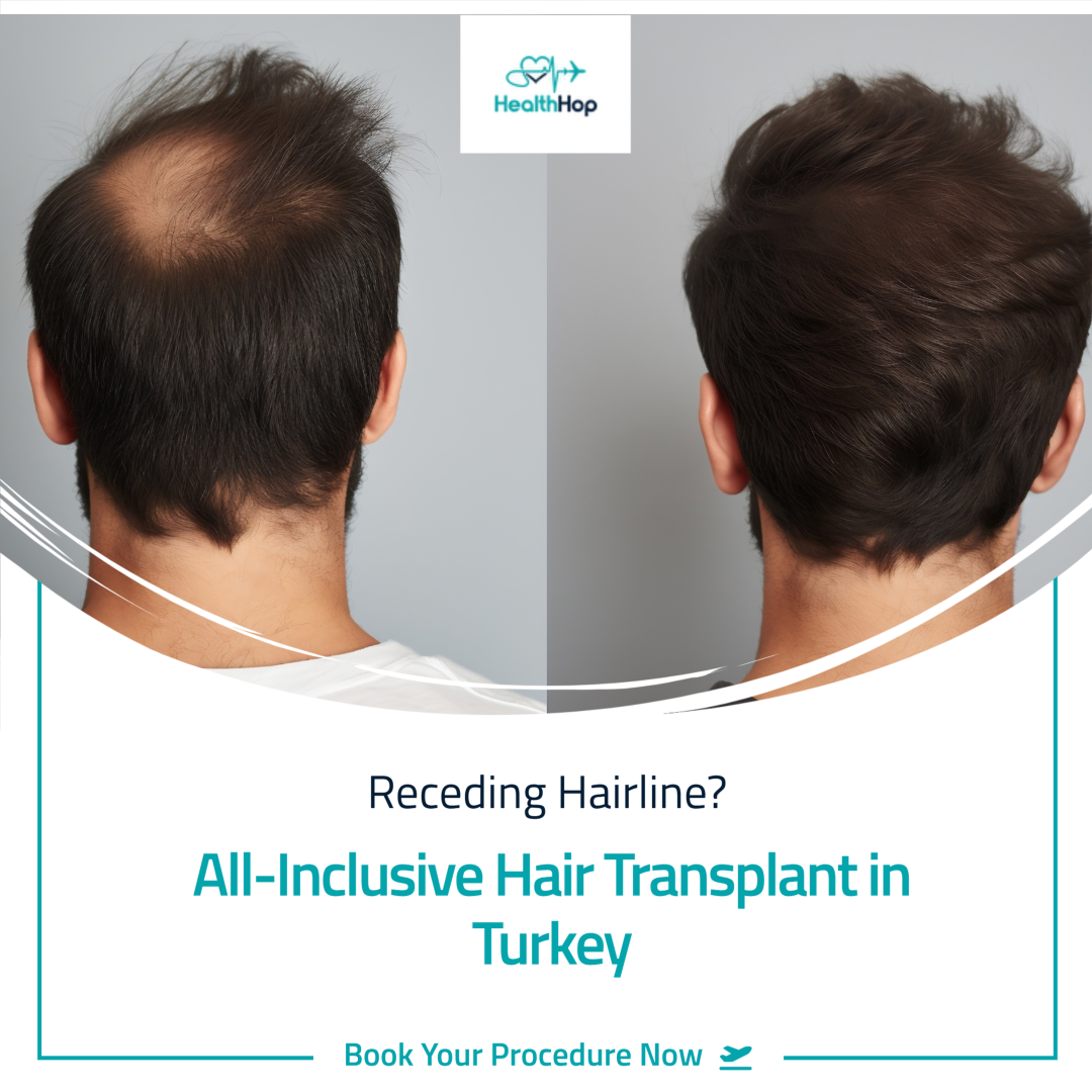hair transplant